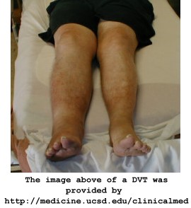 Deep vein thrombosis (DVT) image