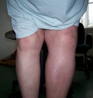 picture of leg swollen from blood clot: DVT survivor Jackie Davis